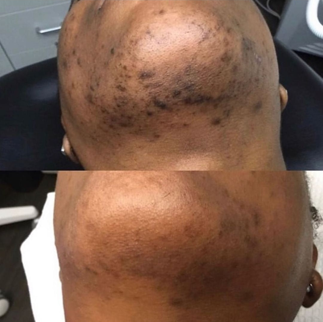 Bump Scrub ( ingrown, razor bumps)by Thowbie